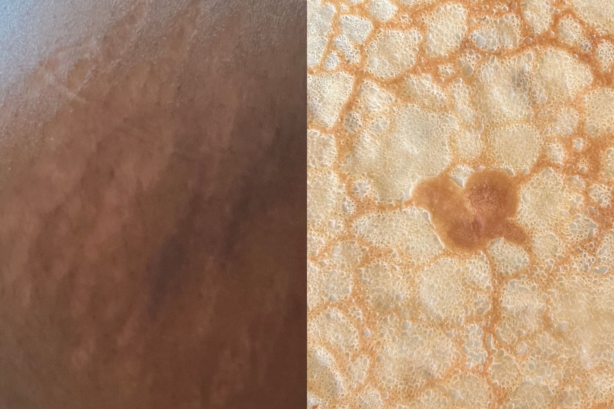 Image of stretch marks compared to a pancake