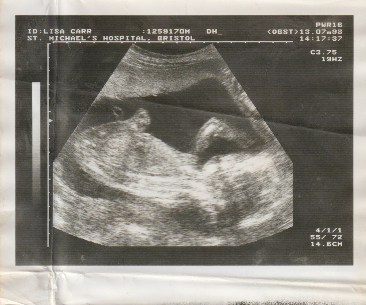 Baby scan